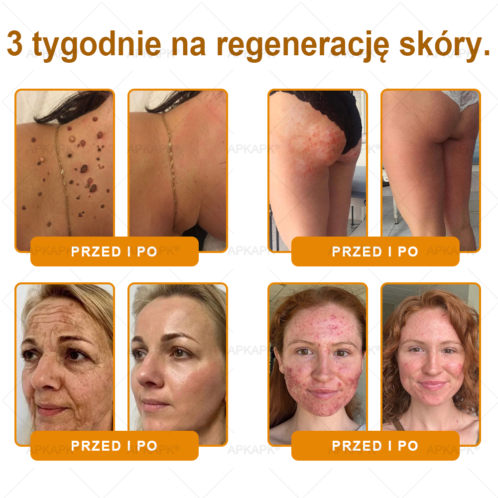 🐝ΑPΚΑPK® Jad Pszczoły Kompleksowy Krem✨pomaga w leczeniu problemów skórnych, takich jak: zmarszczki, blizny, plamy pigmentacyjne, rozstępy, trądzik, łuszczyca, egzema, zmiany skórne, podrażnienia, stany zapalne i inne problemy skórne🔥