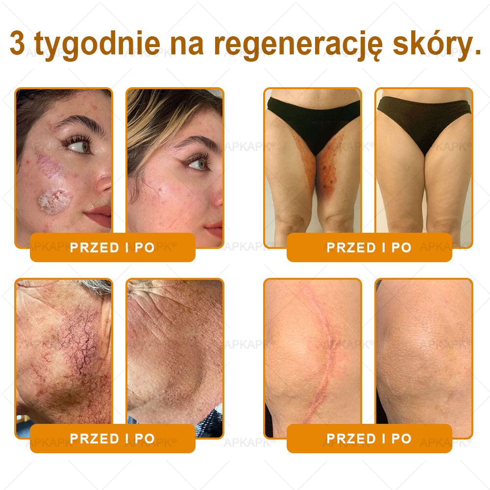 🐝ΑPΚΑPK® Jad Pszczoły Kompleksowy Krem✨pomaga w leczeniu problemów skórnych, takich jak: zmarszczki, blizny, plamy pigmentacyjne, rozstępy, trądzik, łuszczyca, egzema, zmiany skórne, podrażnienia, stany zapalne i inne problemy skórne🔥