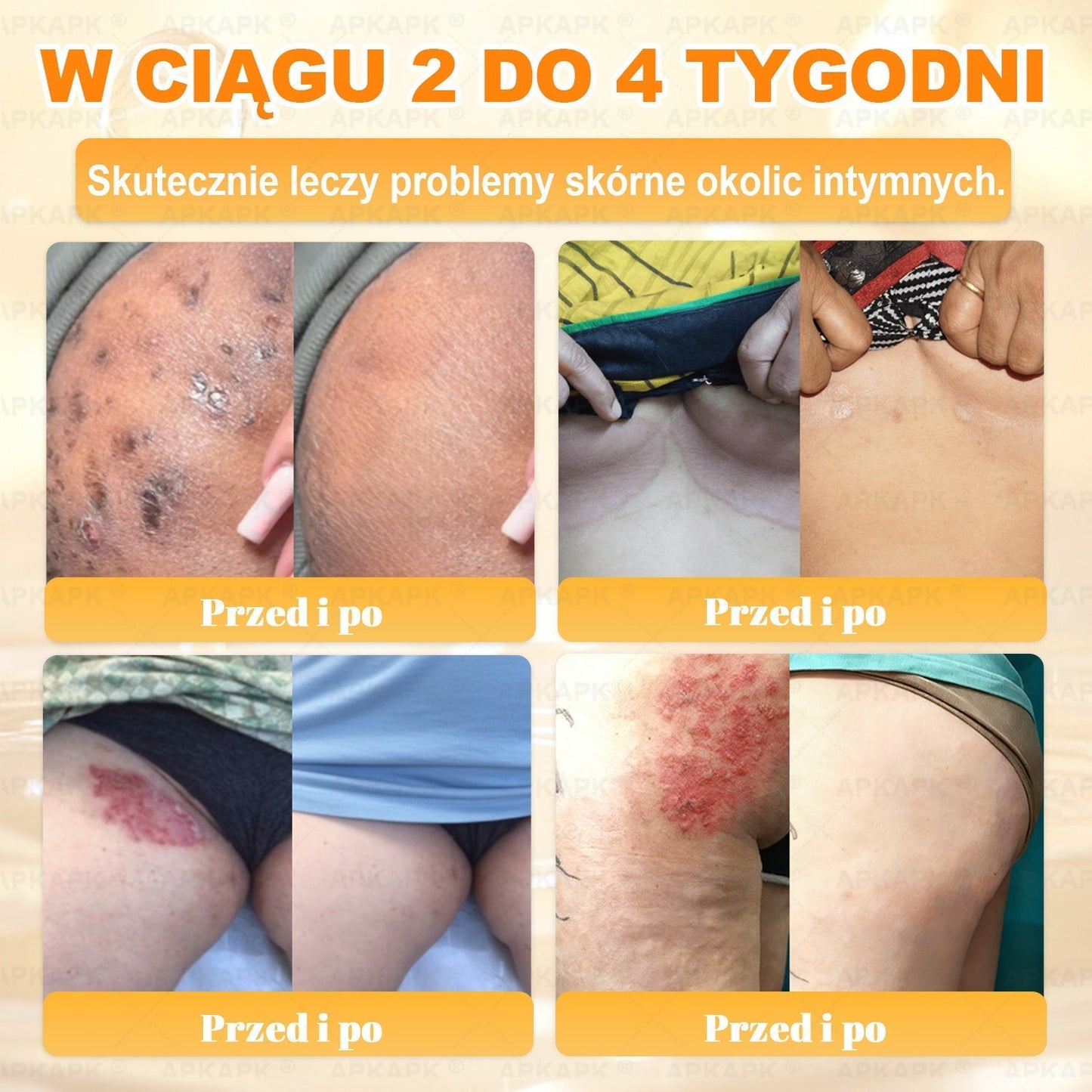 🐝ΑPΚΑPK® Jad Pszczoły Kompleksowy Krem✨pomaga w leczeniu problemów skórnych, takich jak: zmarszczki, blizny, plamy pigmentacyjne, rozstępy, trądzik, łuszczyca, egzema, zmiany skórne, podrażnienia, stany zapalne i inne problemy skórne🔥