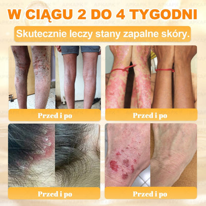 🐝ΑPΚΑPK® Jad Pszczoły Kompleksowy Krem✨pomaga w leczeniu problemów skórnych, takich jak: zmarszczki, blizny, plamy pigmentacyjne, rozstępy, trądzik, łuszczyca, egzema, zmiany skórne, podrażnienia, stany zapalne i inne problemy skórne🔥